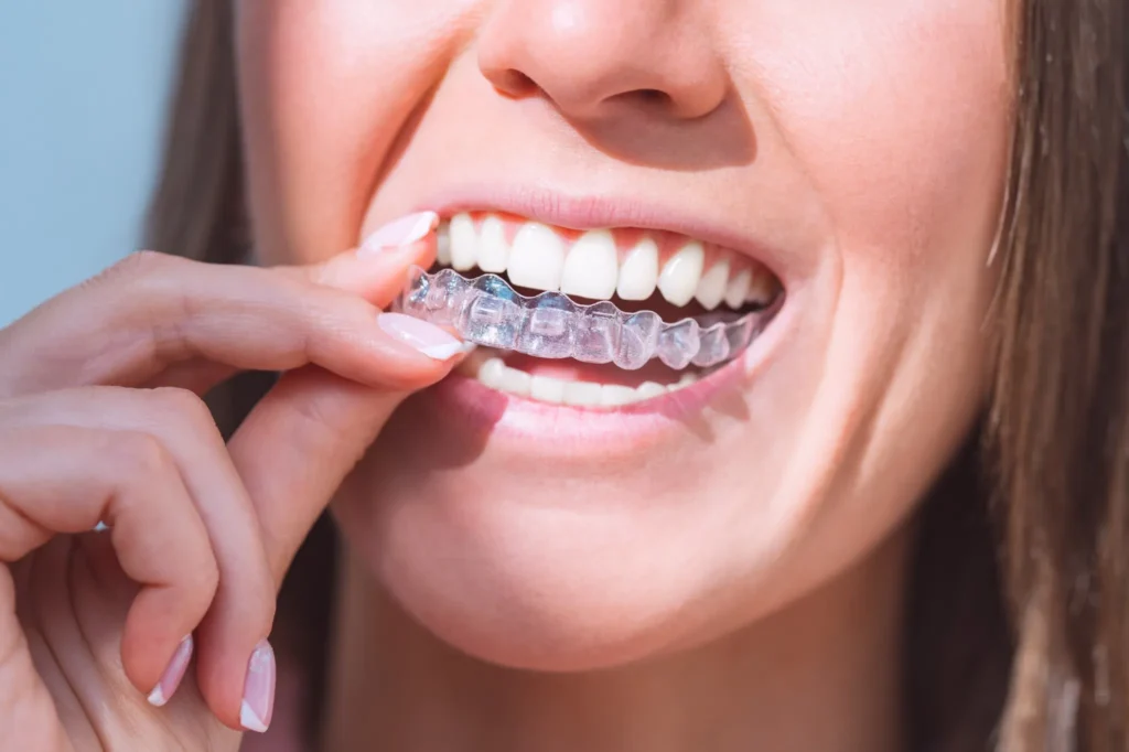 Woman inserting a clear custom dental mouthguard for teeth protection