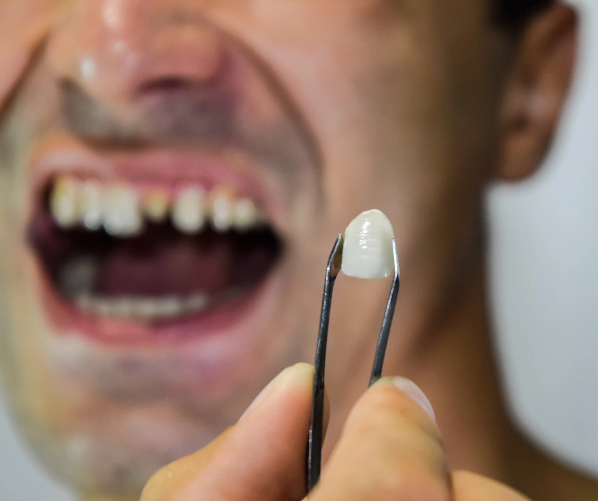 Dental veneer held before tooth restoration