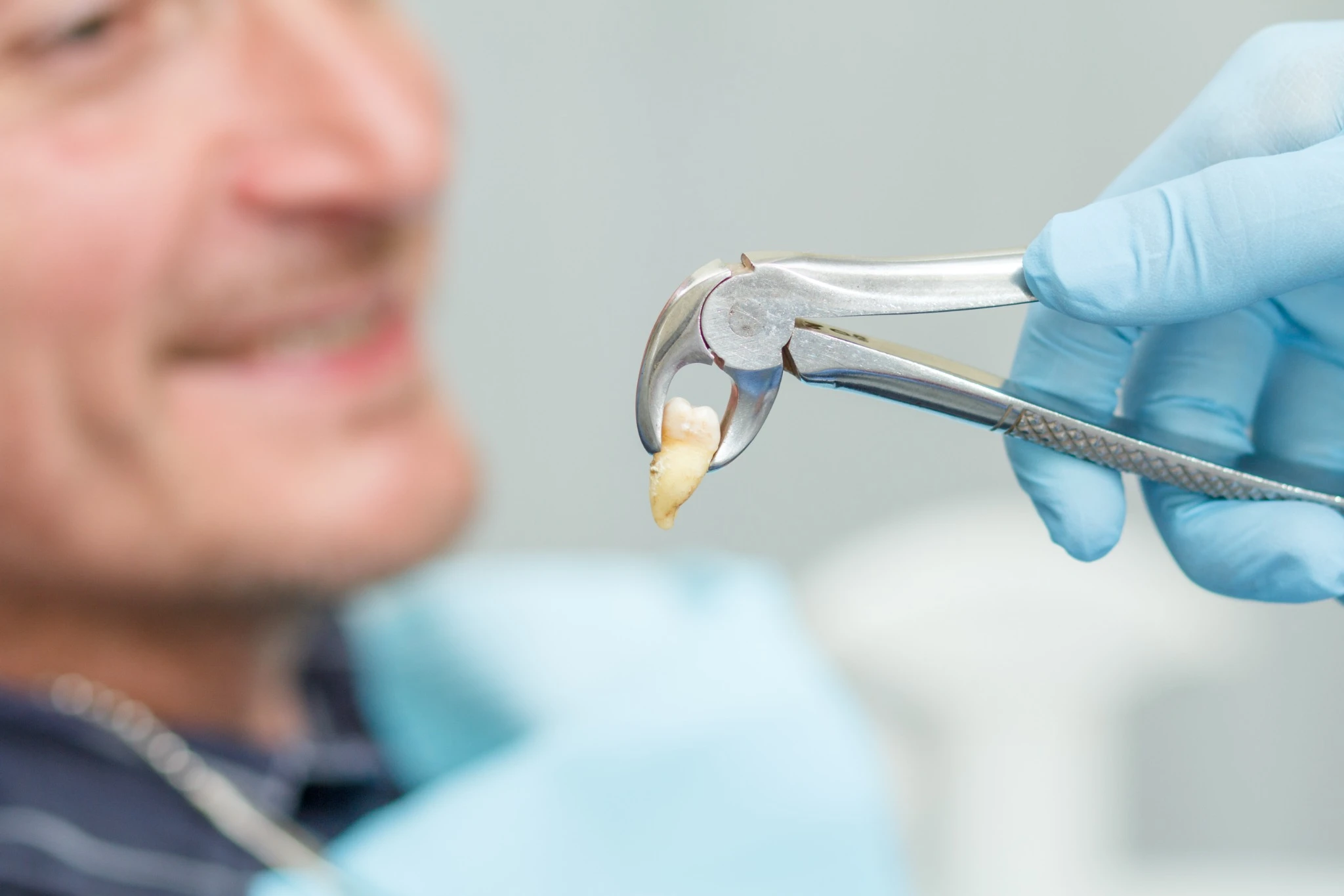 Extracted decayed tooth held with dental pliers